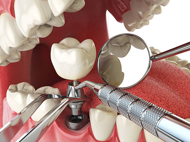 Best Emergency Tooth Extraction in Mmerce City, CO